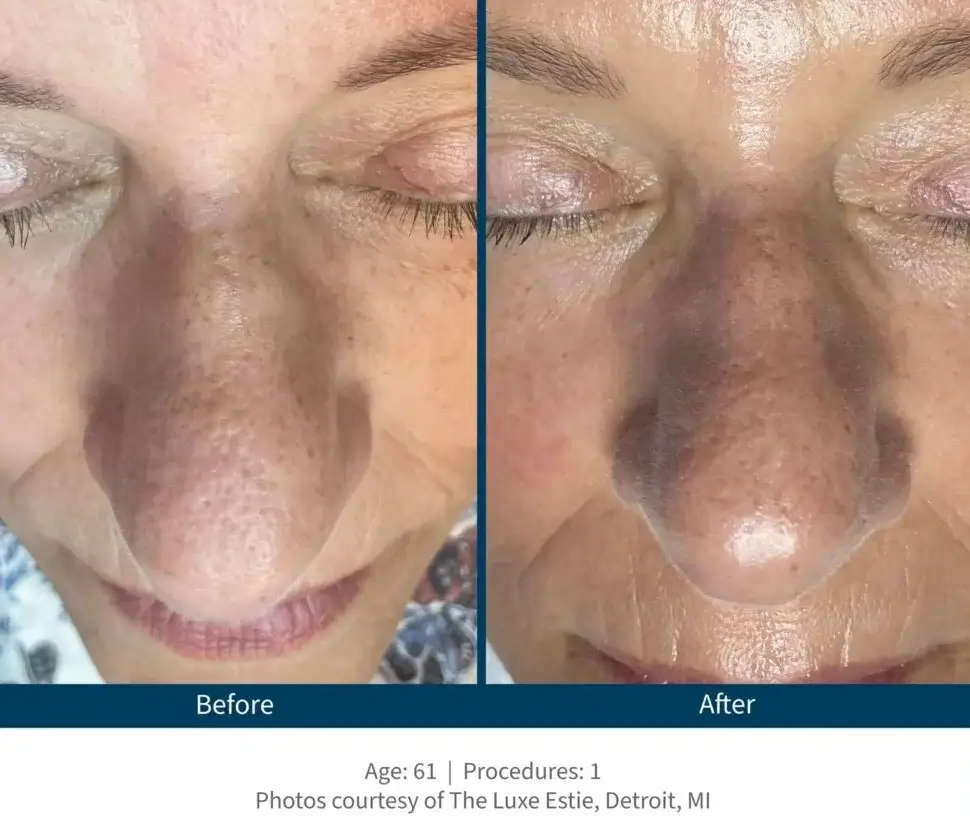 Vorher-Nachher Behandlungsergebnis mit Skinpen Microneedling