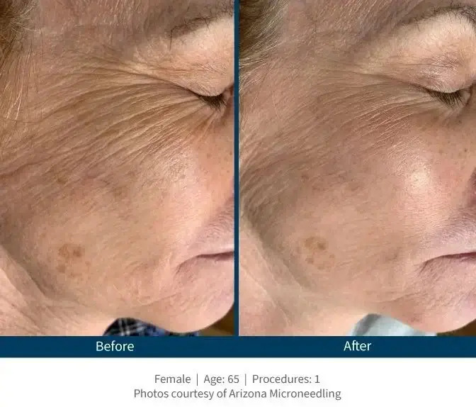 Vorher-Nachher Behandlungsergebnis mit Skinpen Microneedling