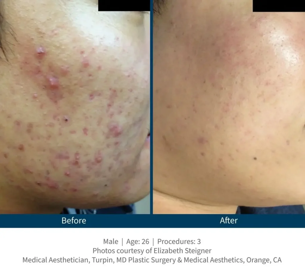 Vorher-Nachher Behandlungsergebnis mit Skinpen Microneedling für Ihn