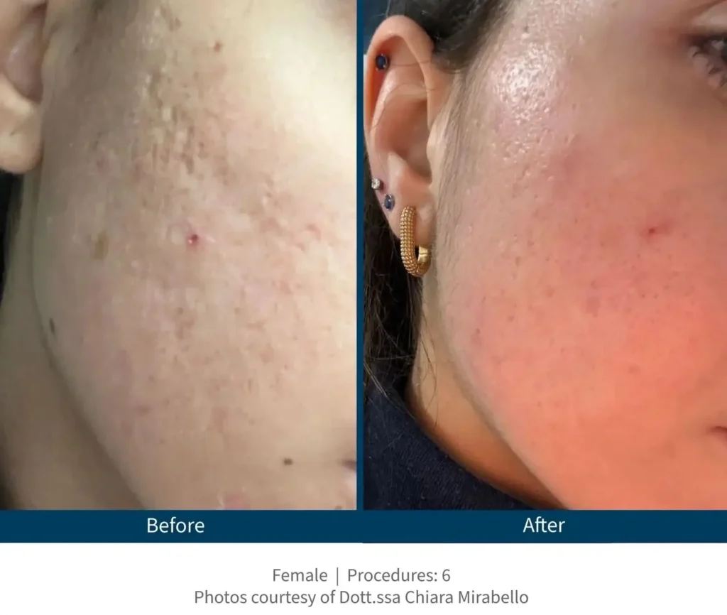 Vorher-Nachher Behandlungsergebnis mit Skinpen Microneedling