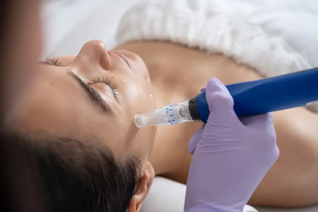 Microneedling - Jetzt bei Nunchi Beauty in Bruchköbel erhältlich