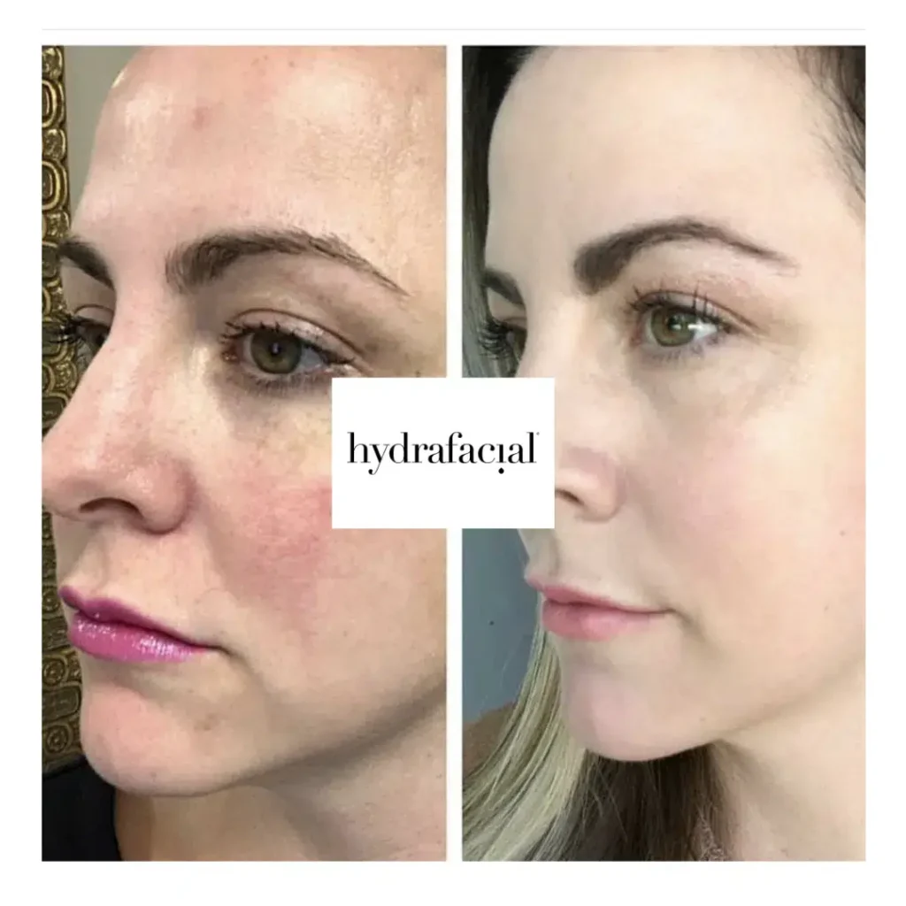 Vorher-Nachher Behandlungsergebnis mit Hydrafacial - Seitenprofil