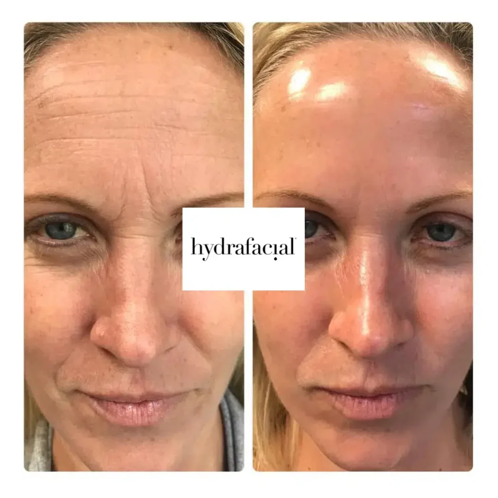 Vorher-Nachher Behandlungsergebnis mit Hydrafacial - Frontal