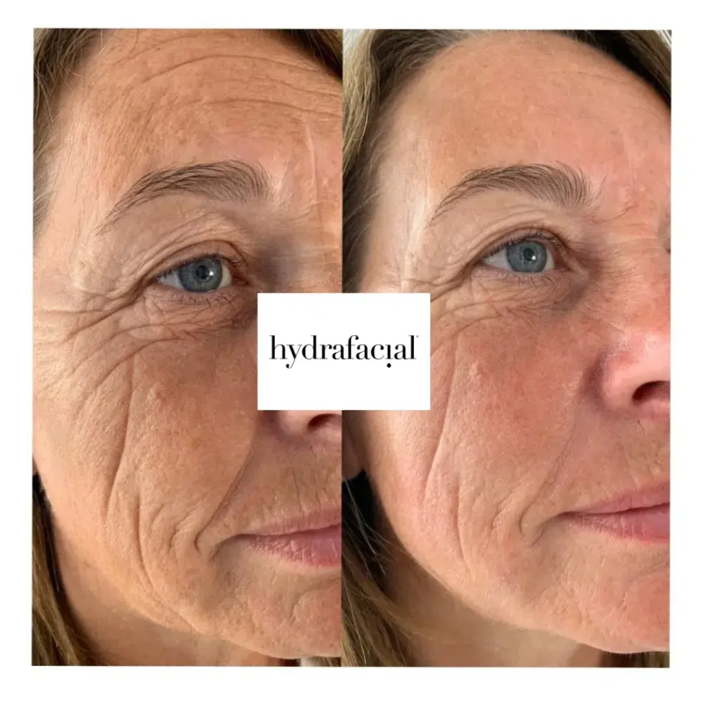 Vorher-Nachher Behandlungsergebnis mit Hydrafacial - Seitenprofil